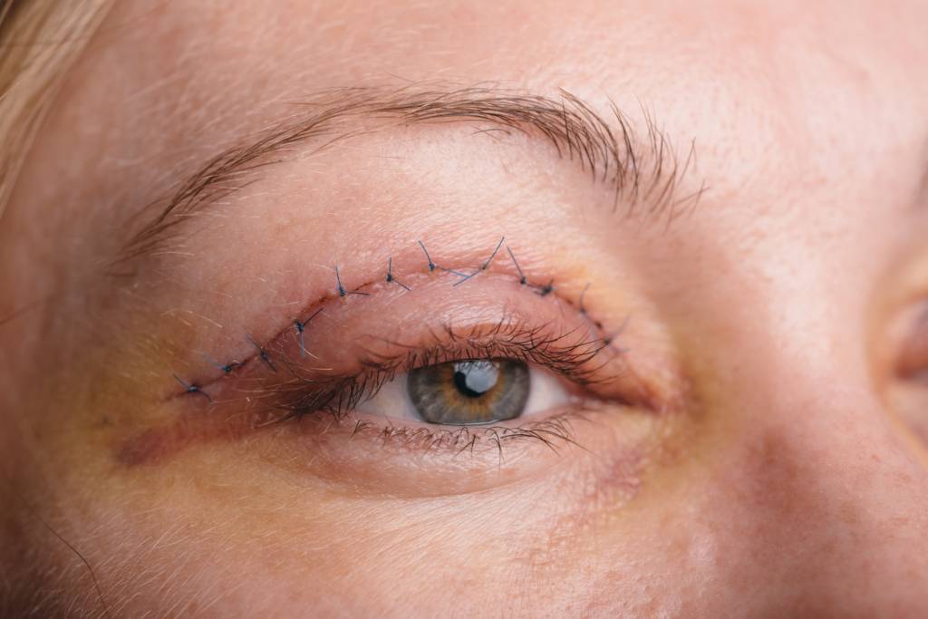 Gros plan de l'œil d'une personne présentant des points de suture chirurgicaux le long de la paupière supérieure, montrant les signes d'une récente opération des paupières et de légères ecchymoses.